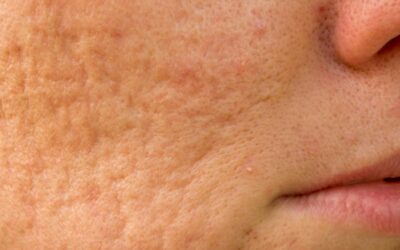 Dites adieu aux cicatrices d’acné grâce au traitement laser !