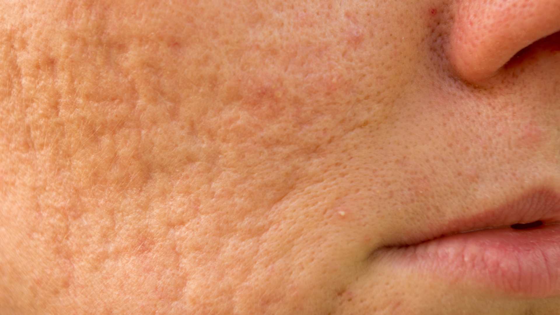 Des cicatrices d'acné